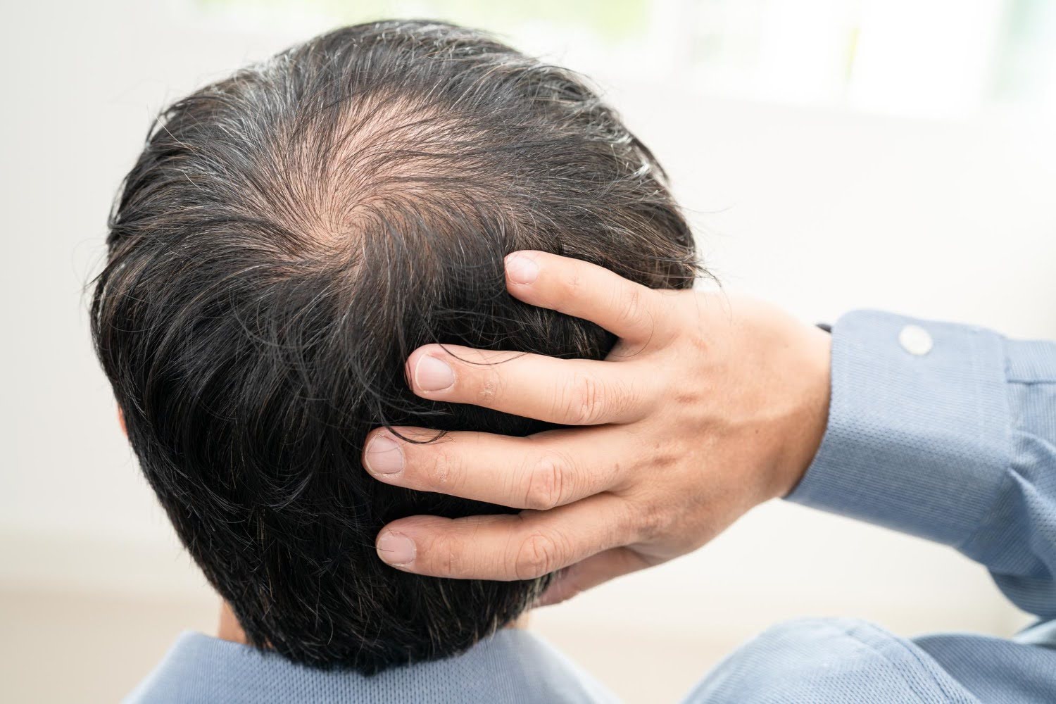 Back view of a man's head showing a thinning crown, with his hand parting the hair